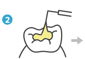虫歯治療②