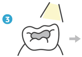 虫歯治療③