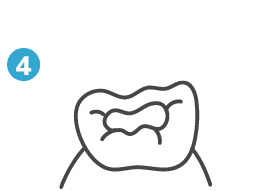 虫歯治療④