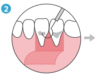 ②歯石の除去